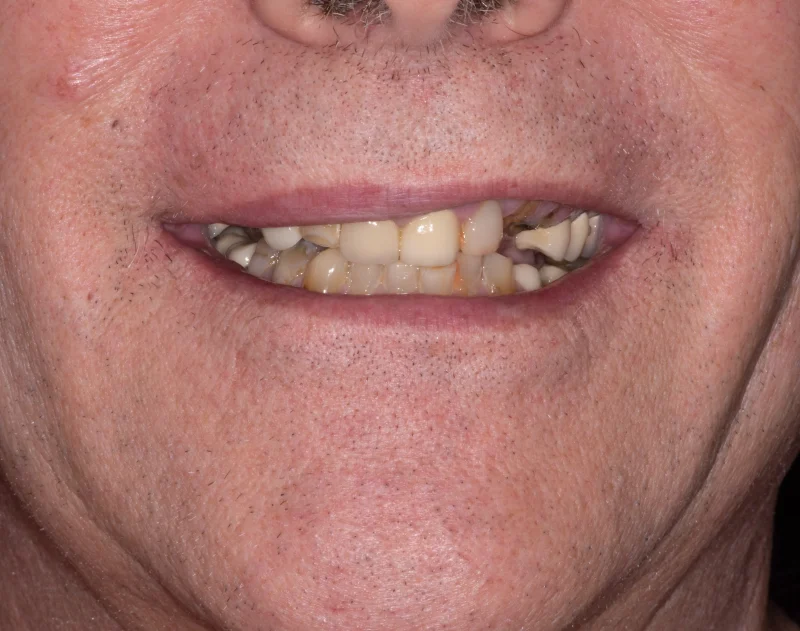 Close-up of a person’s smile with several missing and worn-down teeth.