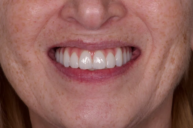 Close-up of a seamless smile restoration with the gap closed and the tooth replaced.