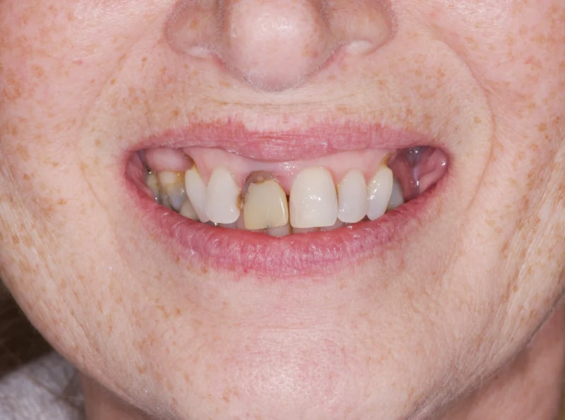 Close-up of a smile with a prominent gap and a missing front tooth.