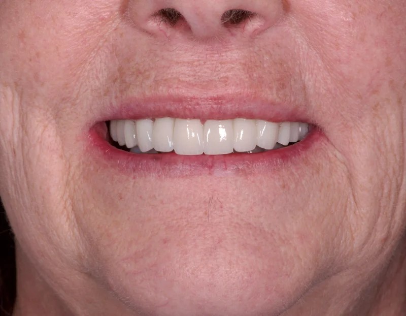 Close-up of a straight and uniform smile after orthodontic or restorative treatment.