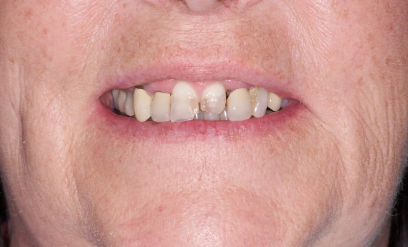 Close-up of a smile with crowded and overlapping upper front teeth.