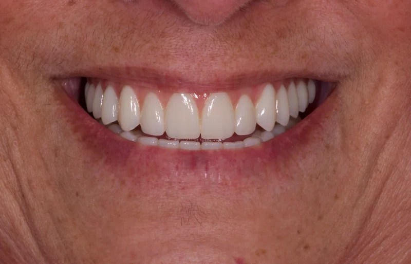 Close-up of a bright, white smile with smooth and evenly shaped teeth.