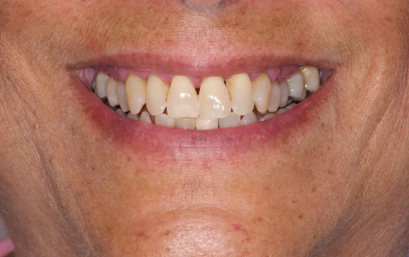 Close-up of a smile with noticeable yellowing and minor chips on the tooth edges.