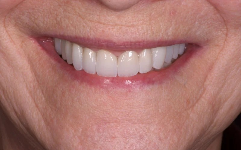 Close-up of a revitalized smile featuring bright white veneers and improved alignment.