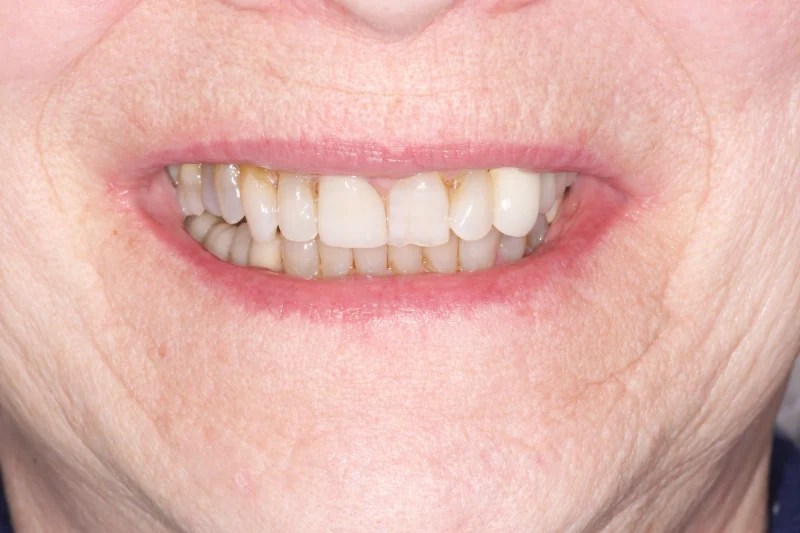 Close-up of a smile showing dull, discolored teeth with uneven alignment.