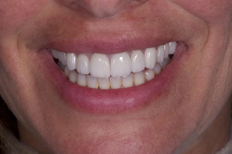 Close-up of a complete smile with the missing tooth replaced by a natural-looking implant.