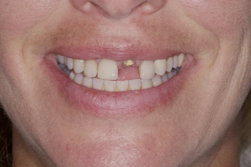 Close-up of a smile with a significant gap from a missing upper front tooth.