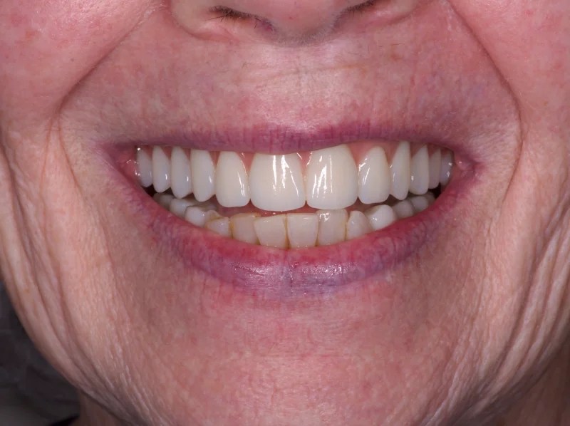 Close-up of a full mouth restoration with a healthy and complete set of white teeth.