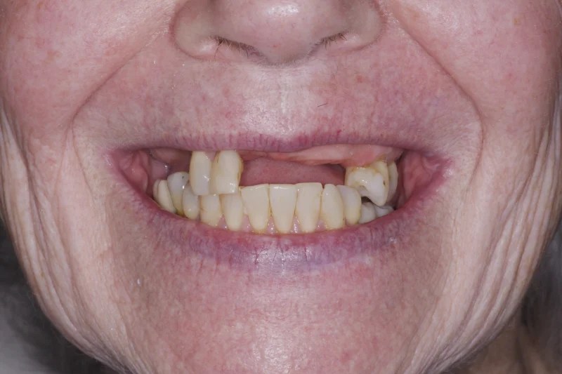 Close-up of a smile with several missing teeth and visible decay on the remaining teeth.