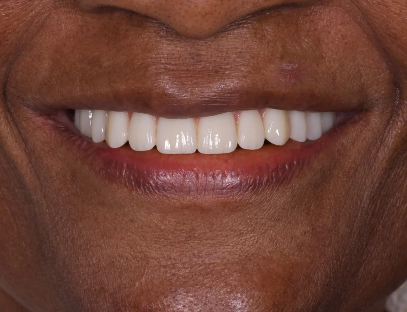 Close-up of a full smile restoration showing a complete set of white, well-aligned teeth.