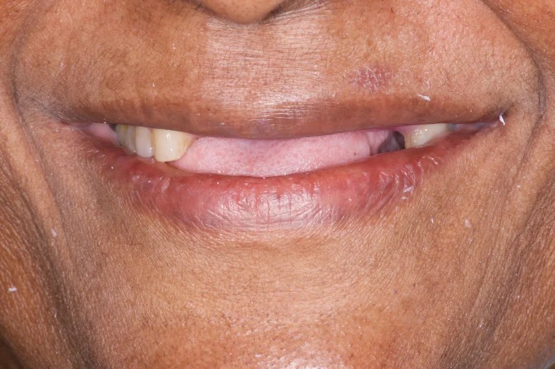 Close-up of a smile with an almost entirely missing upper arch of teeth.