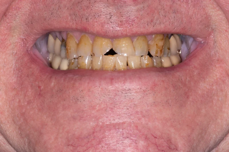 Close-up of teeth with severe yellowing, staining, and visible gaps.