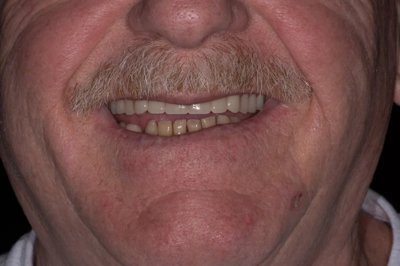 Close-up of a rejuvenated smile featuring full upper dental restorations.