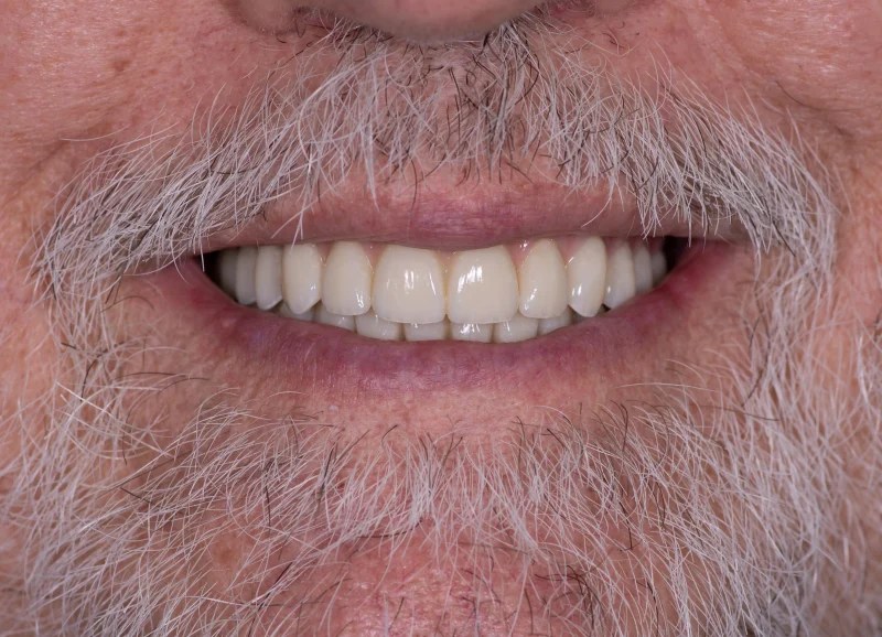 Close-up of a full smile restoration for an older patient with natural-looking white teeth.