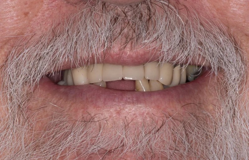 Close-up of an older patient’s smile showing significant tooth loss on the upper jaw.