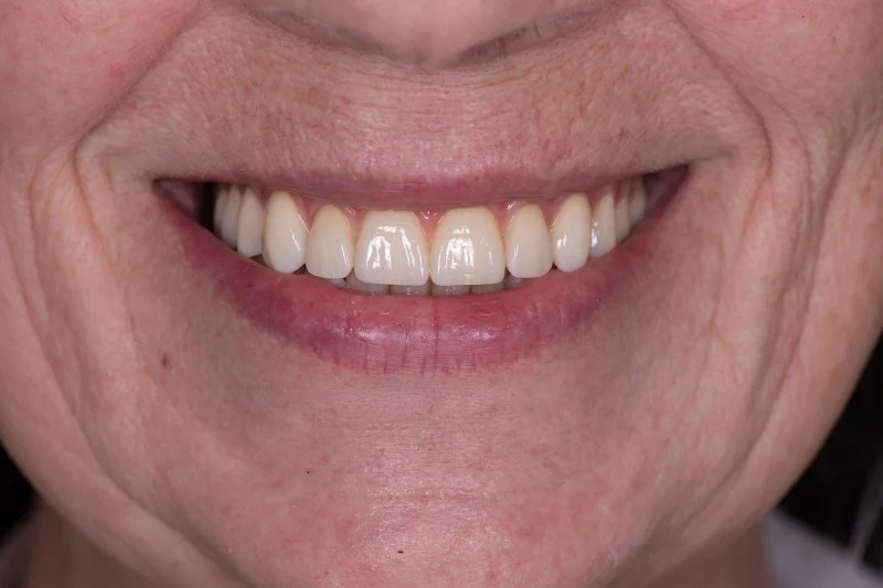 Close-up of a bright, symmetrical smile with full dental veneers.