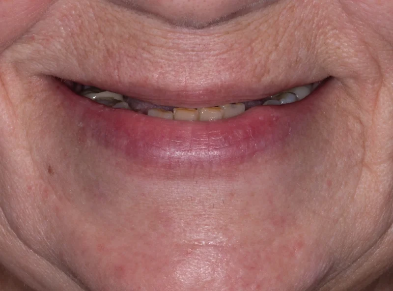 Close-up of a smile with small, unevenly spaced, and worn teeth.