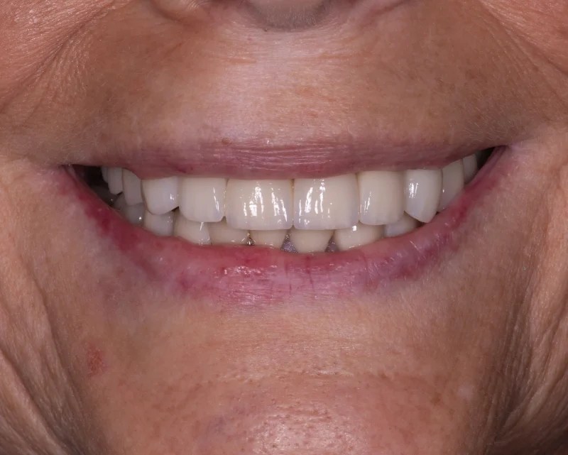 Close-up of a clean, aesthetic smile with modern, white porcelain crowns.