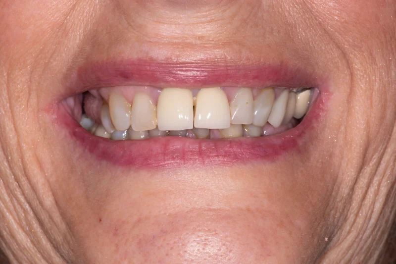 Close-up of a smile showing stained teeth and visible metal from old dental work.