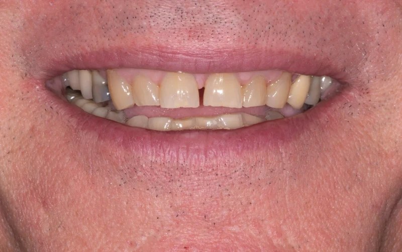 Close-up of a patient with a thin smile and missing teeth.