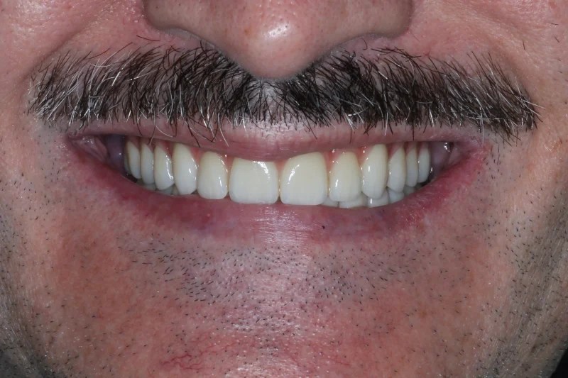 Close-up of the same patient with a perfectly aligned and brightened smile.