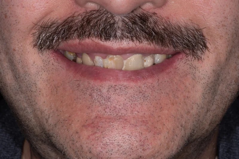 Close-up of a mustache-wearing patient with discolored and misaligned teeth.