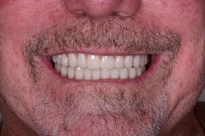 Close-up of a healthy smile with restored gum line and white dental bridges.