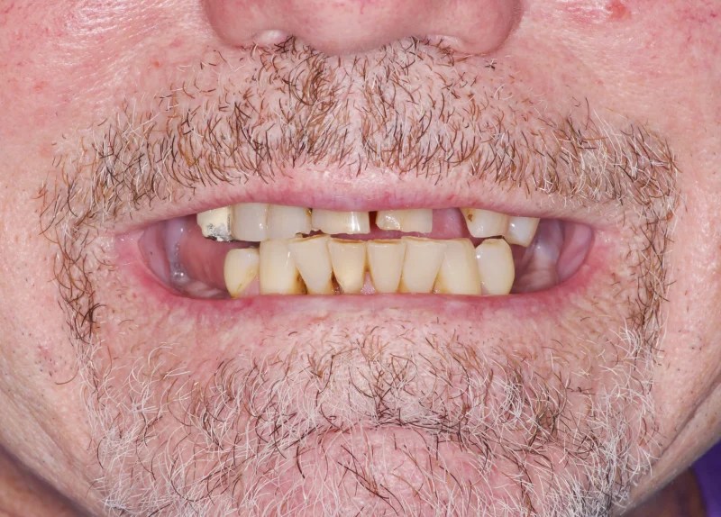 Close-up of a smile with severe gum recession and yellowed, damaged teeth.