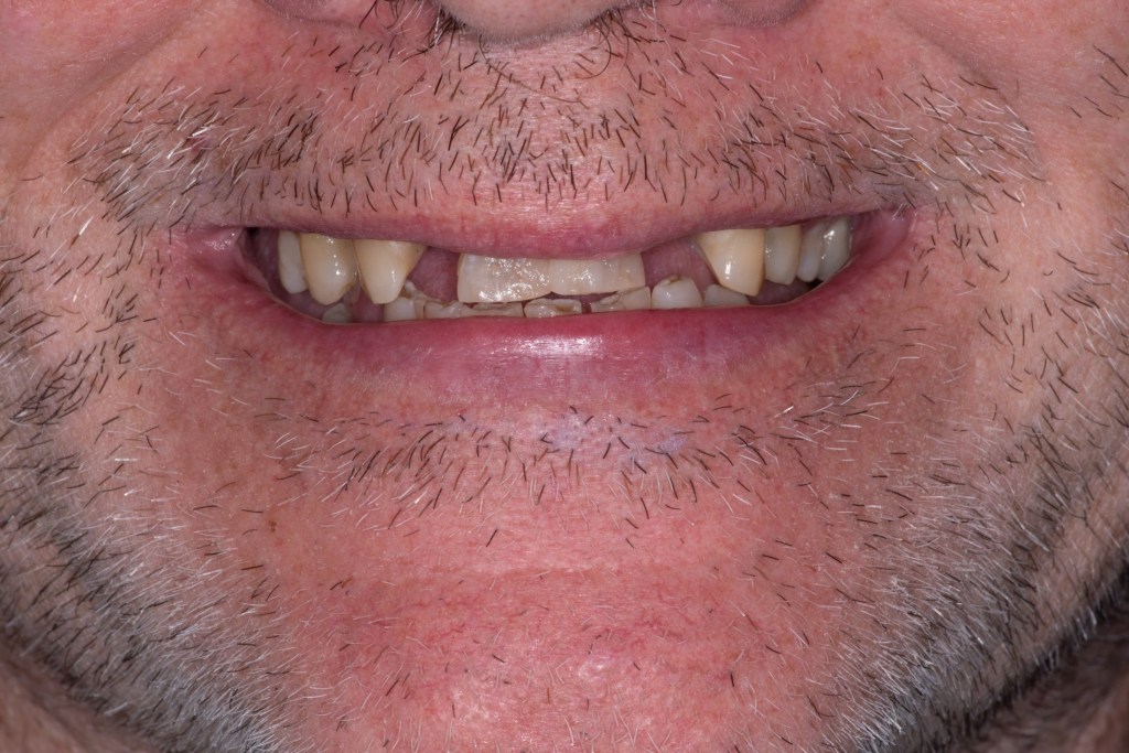 Close-up of a smile with missing and crooked teeth
