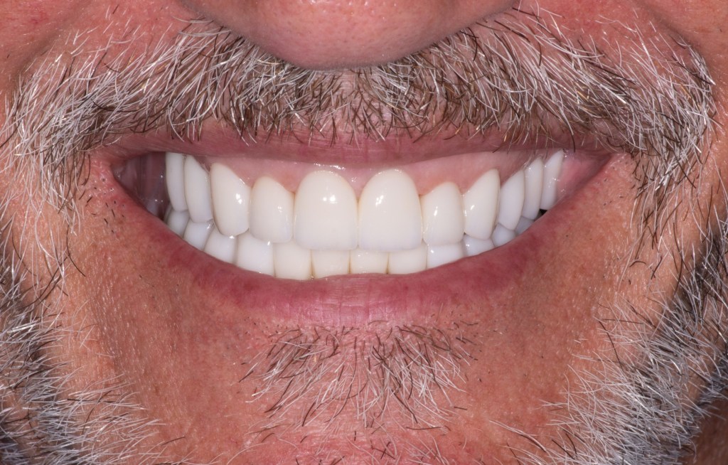 Close-up of a moustache wearing patient with a healthy smile and restored teeth