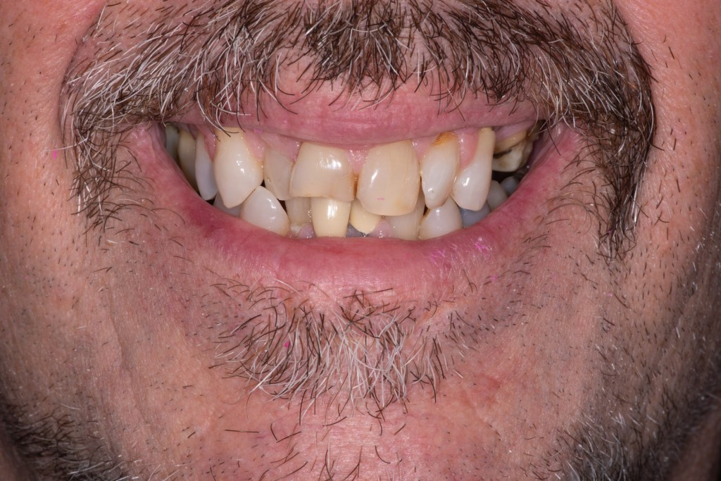Close-up of a smile with crooked and discolored teeth