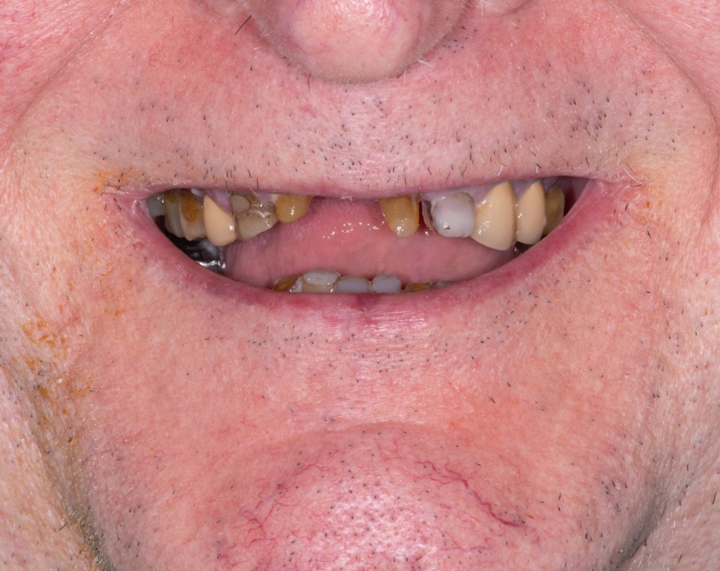 Close-up of a smile with missing and discolored teeth