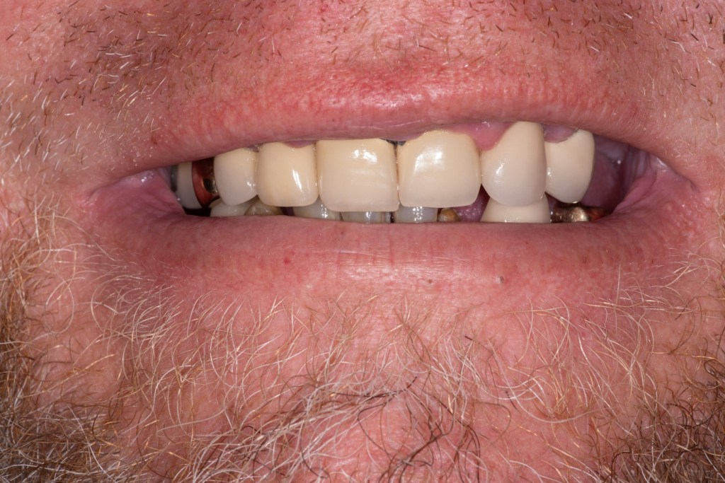 Close-up of a smile with damaged teeth