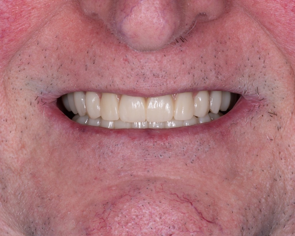 Close-up of a smile with straight, clean teeth