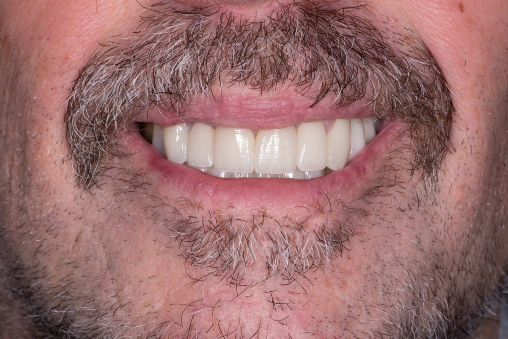Close-up of a smile with straight, white and beautiful teeth