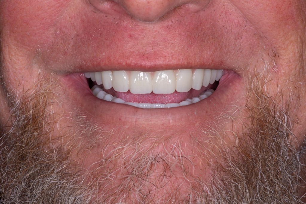Close-up of a smile after restoration
