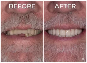 Before and after dental implants on a male patient