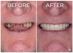 Before and after dental implants on a male patient